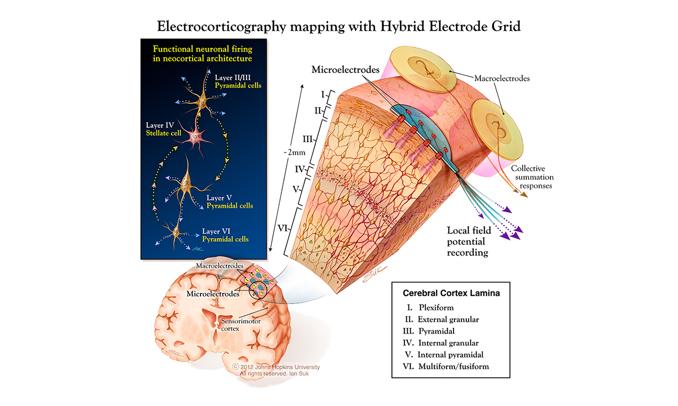 A medical illustration details a hybrid electrode grid implanted in the brain to record neurostimulation activity